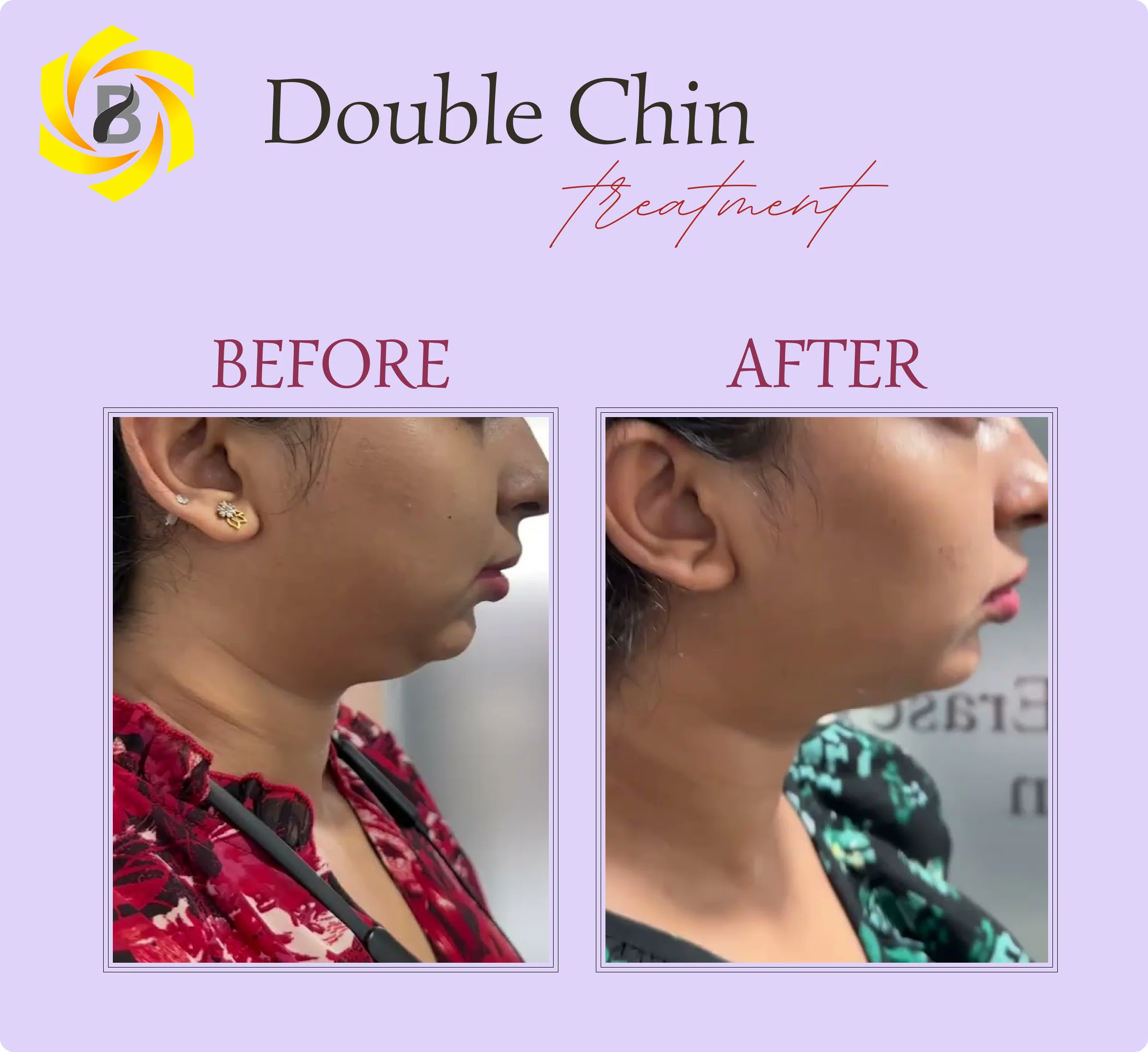 Before & After Result