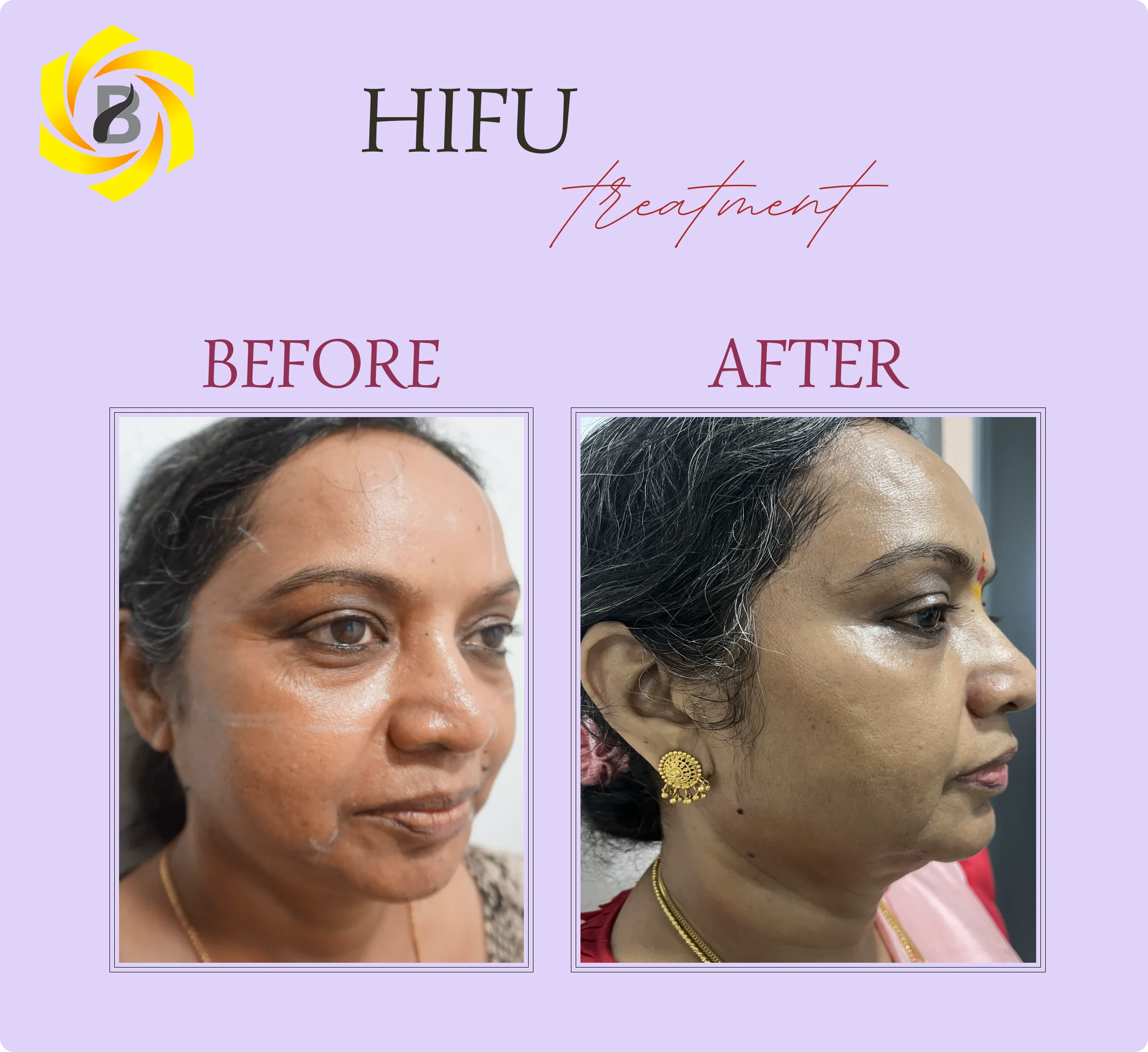 Before & After Result