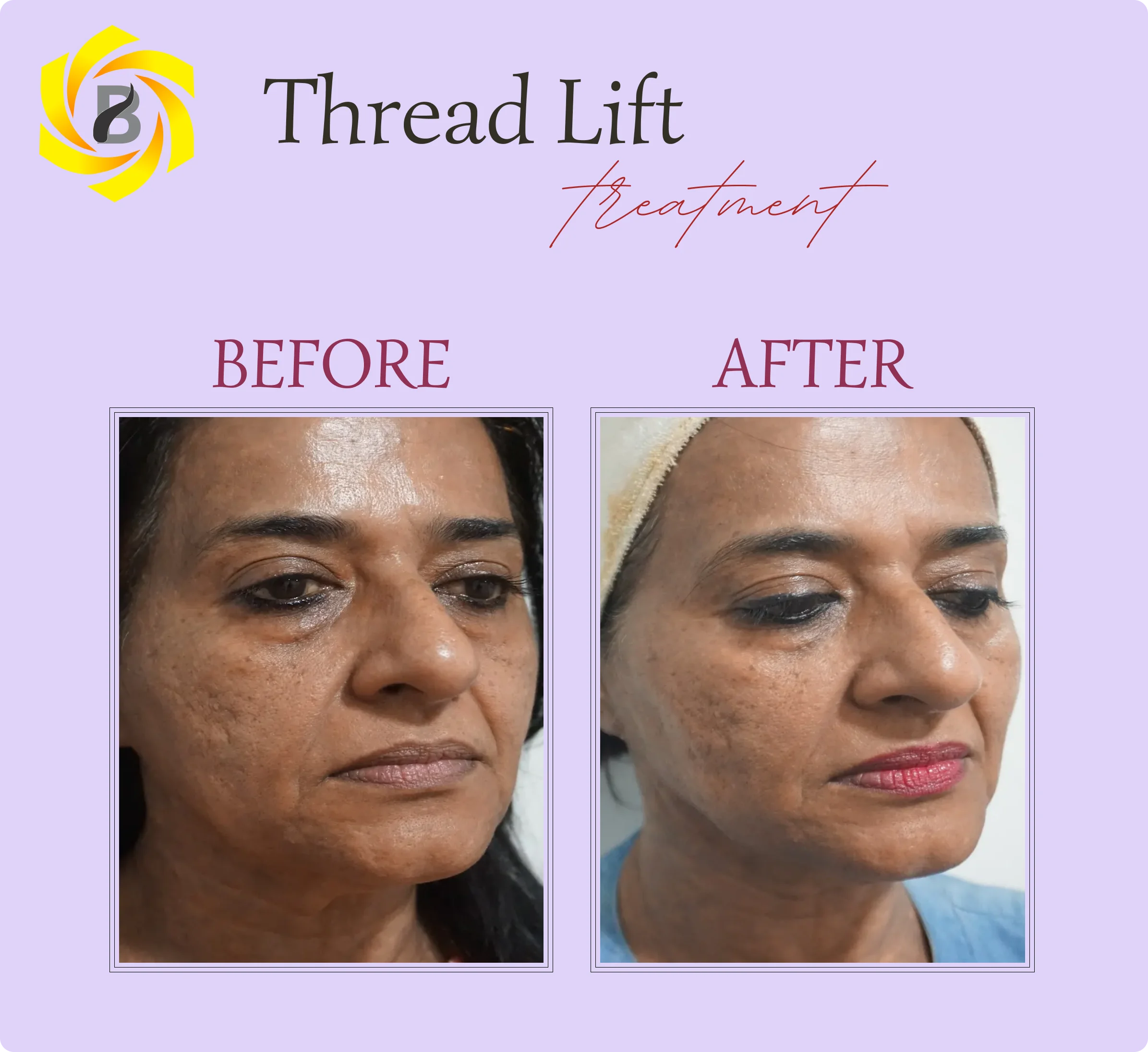 Before & After Result