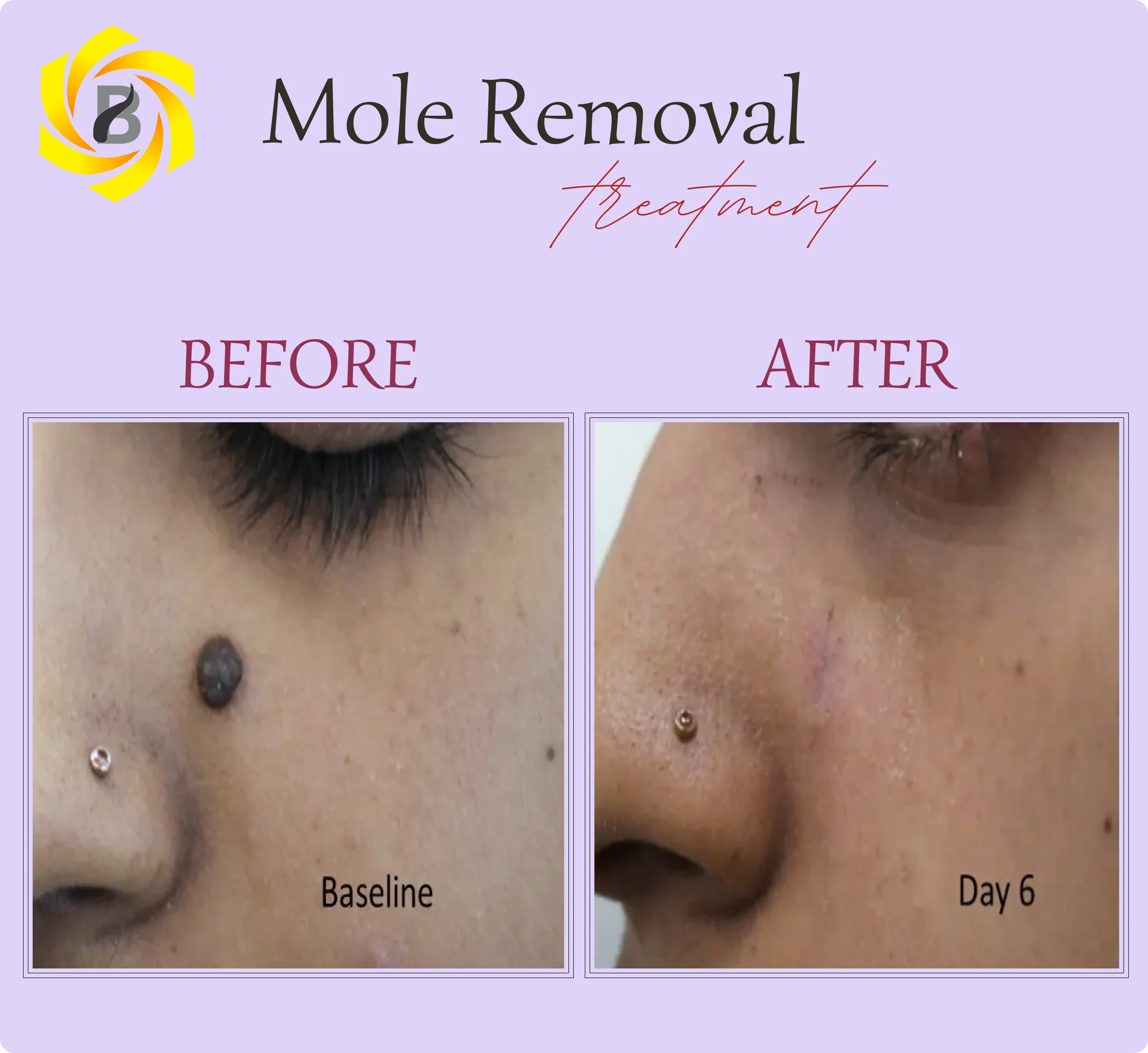 Before & After Result
