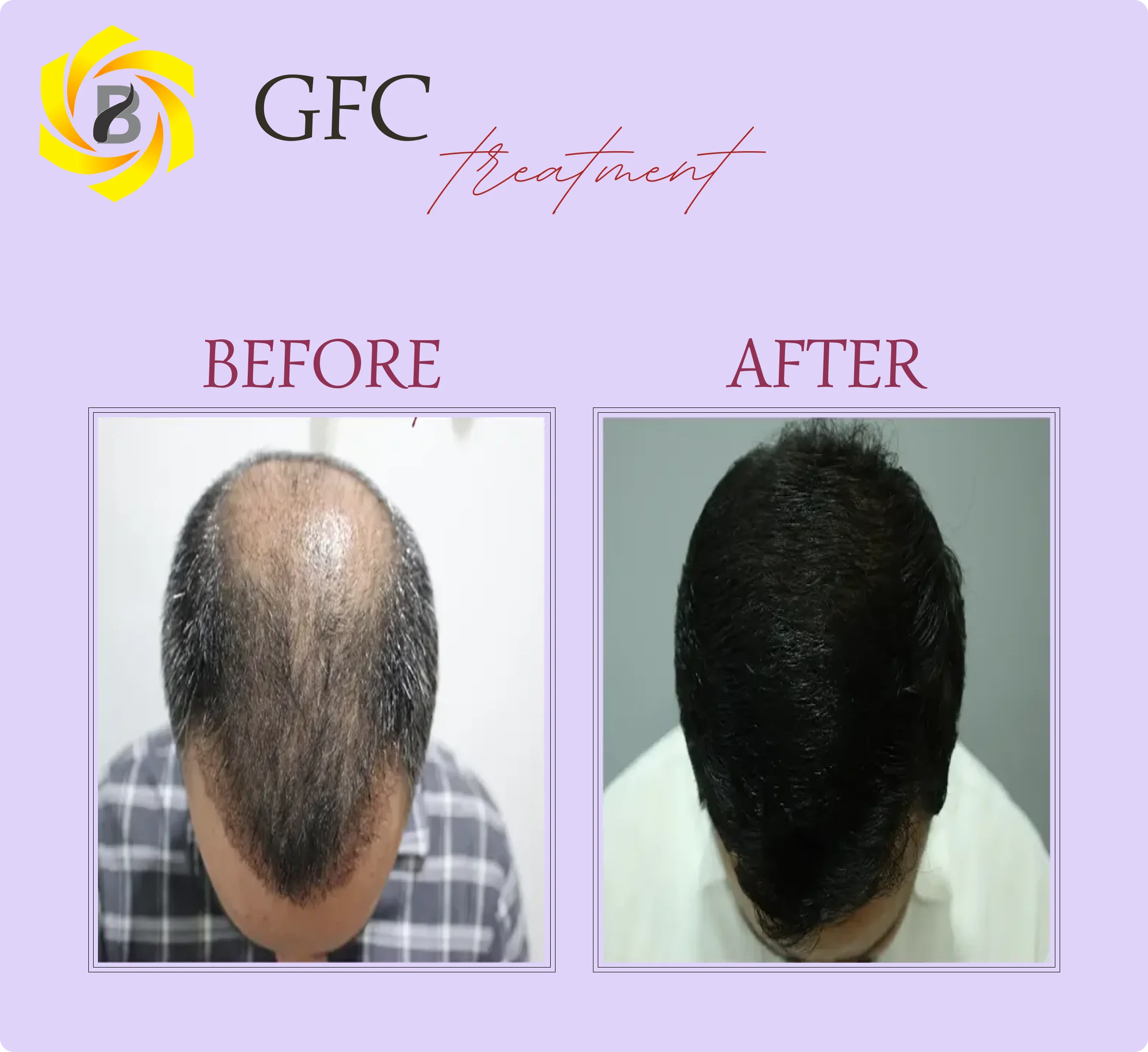 Before & After Result 4