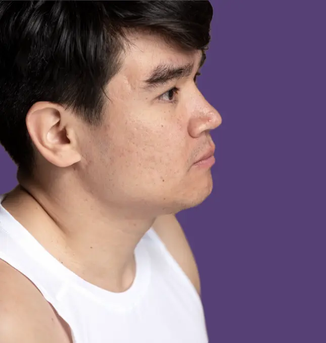 Acne Scar Treatment