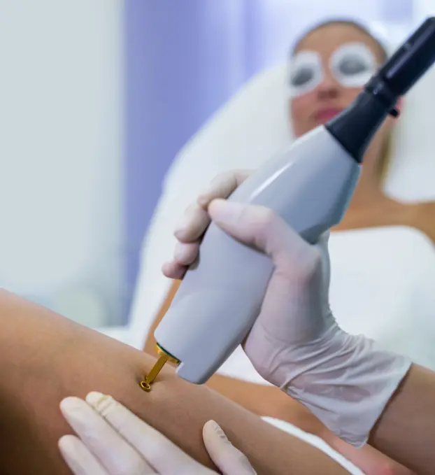 Laser Birth Mark Removal