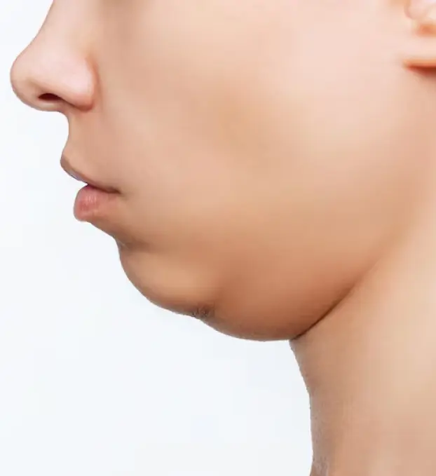 Double Chin Treatment