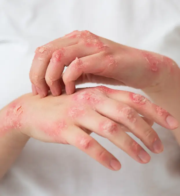 Eczema Treatment