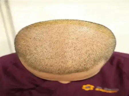 Follicular Stem Cell Therapy FSCT before hair transplant result