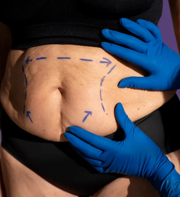 Autologous Fat Transfer