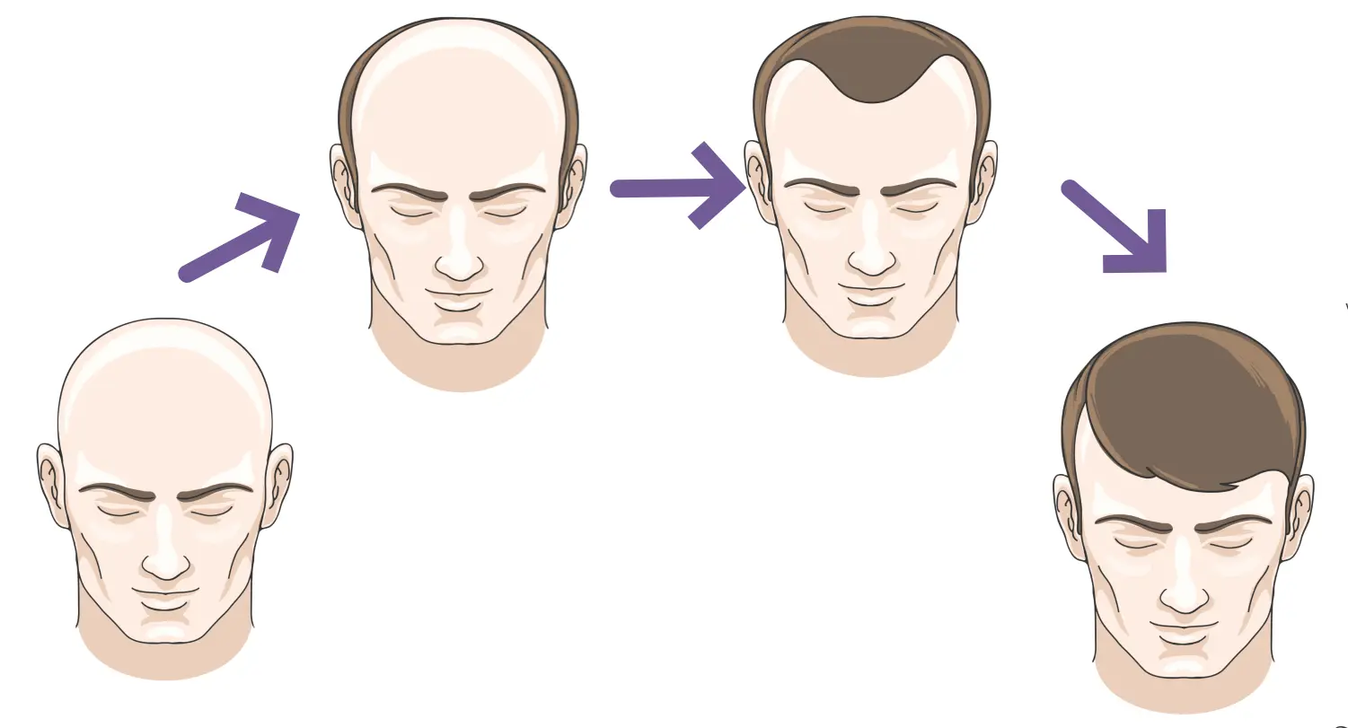 Hair Transplant