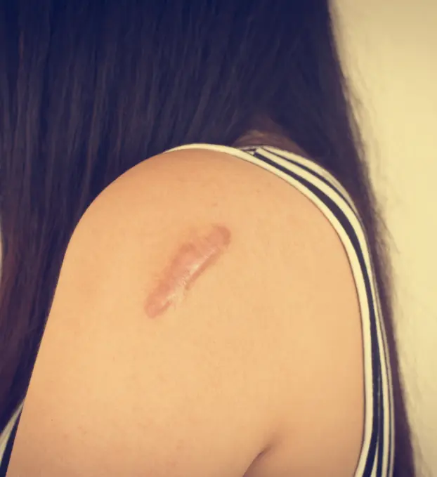 Keloid Treatment
