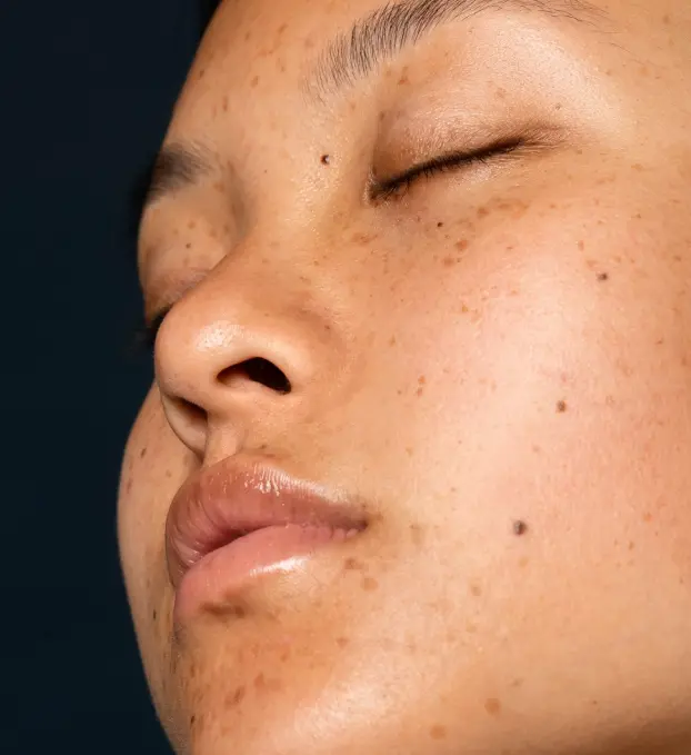 Melasma Treatment