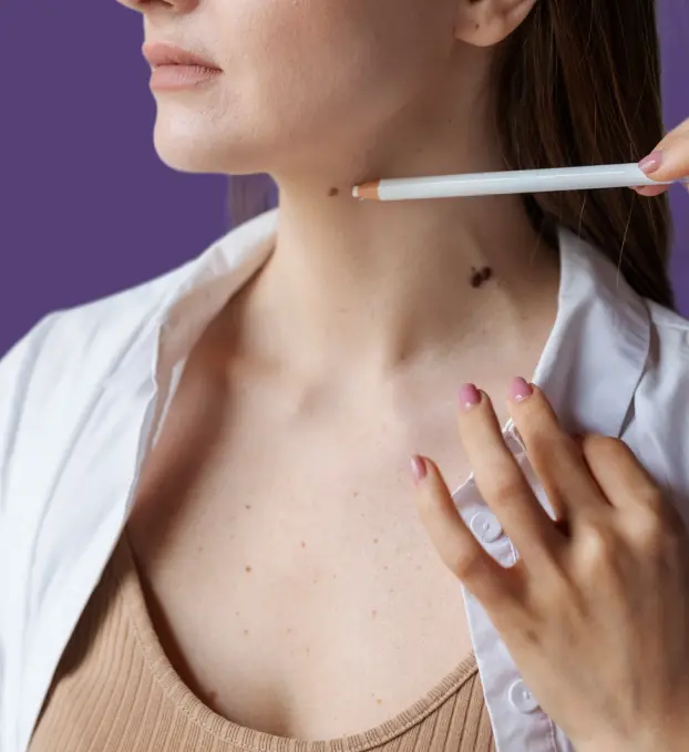 Mole Removal