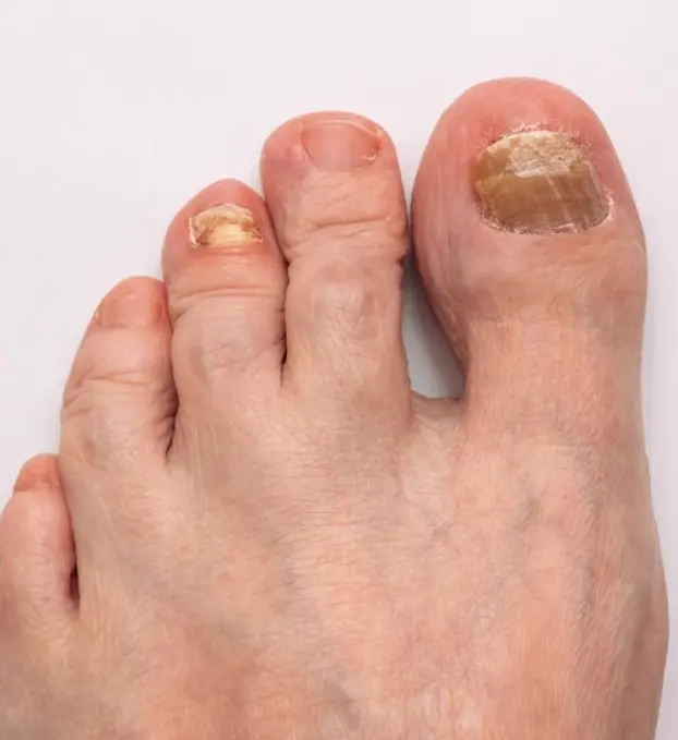Fungal Infection Treatment