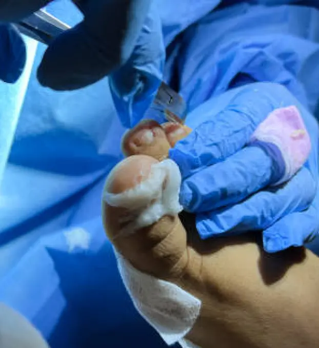 Nail Surgery