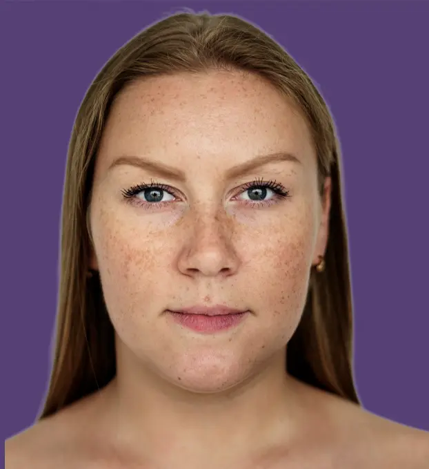 Pigmentation Reduction
