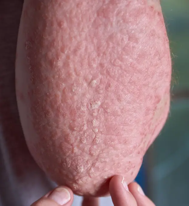 Psoriasis Treatment