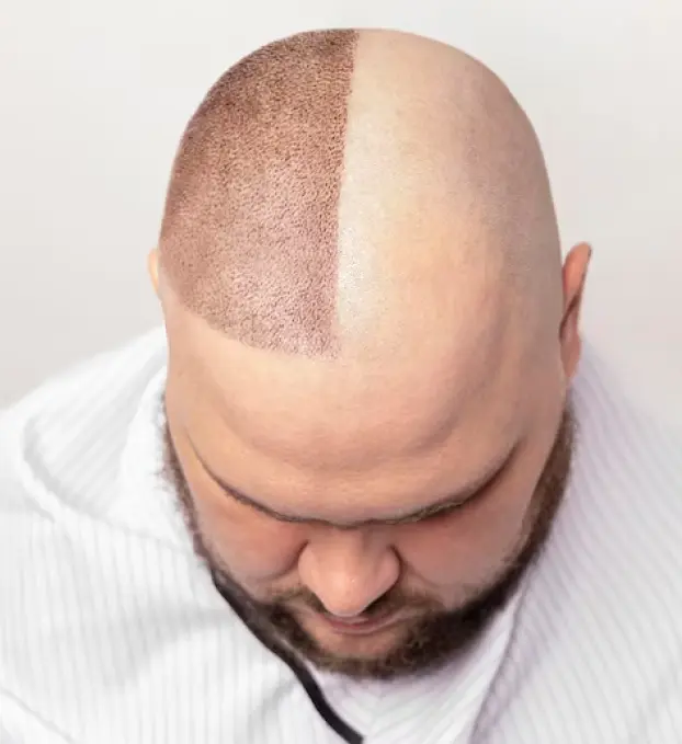 Scalp Micro-Pigmentation