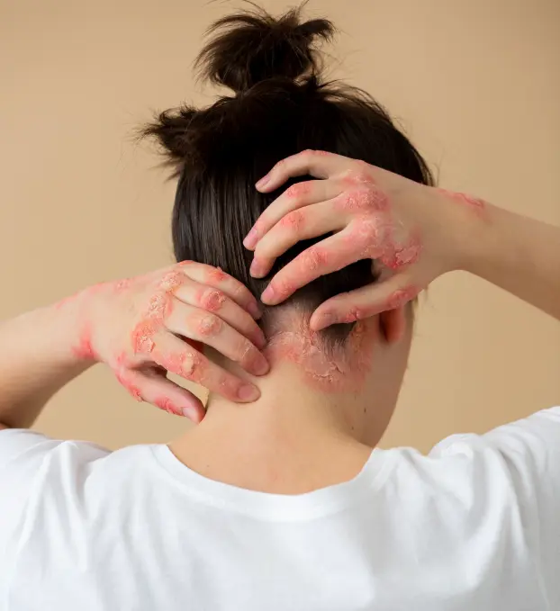 Seborrheic Dermatitis Treatment