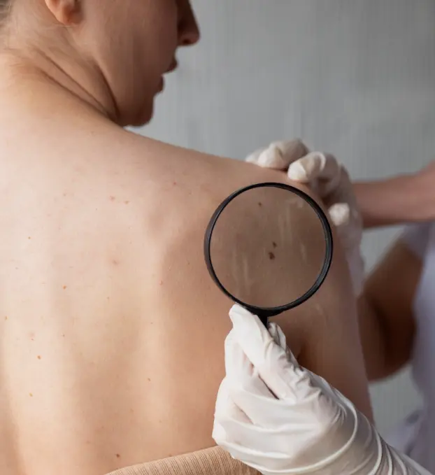 Skin Tags Treatment