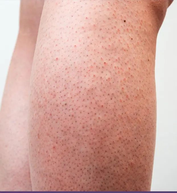 Strawberry Legs Treatment