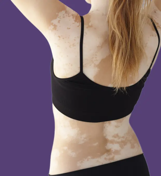 Vitiligo Surgery