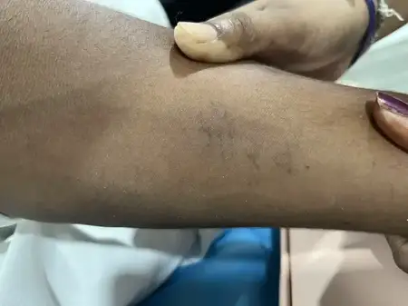 Tattoo removal treatment after result at Radiance Clinic