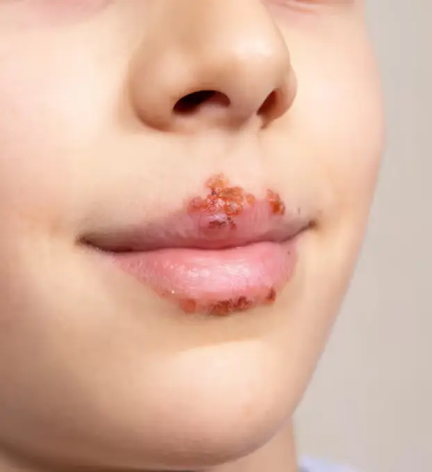 Herpes Treatment