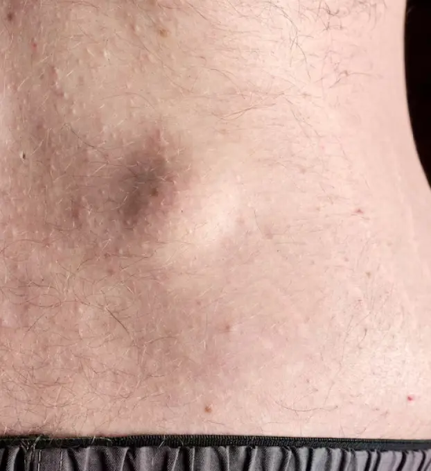 Cyst & Lipoma Removal